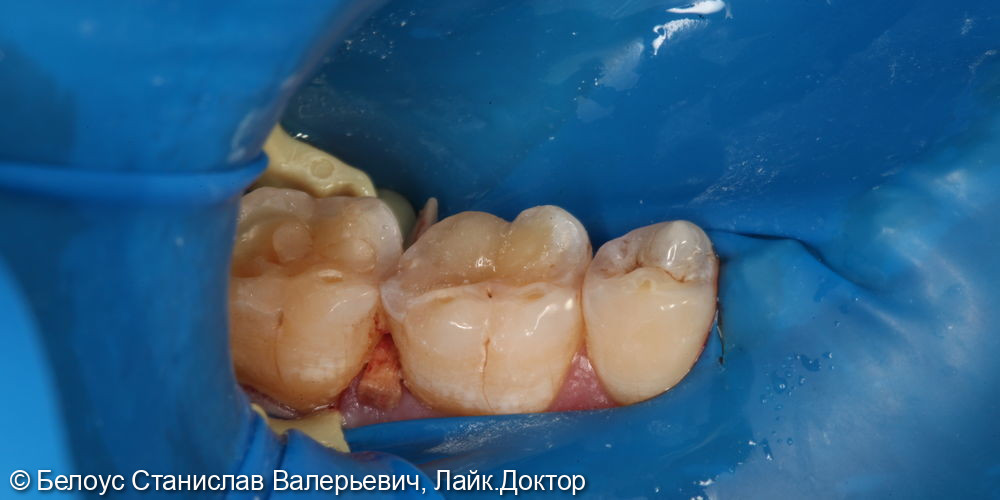 Лечение кариеса на 4.6 зубе - фото №2