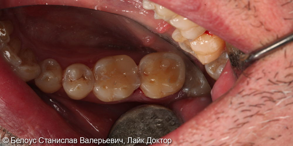 Лечение кариеса на 4.6 зубе - фото №4