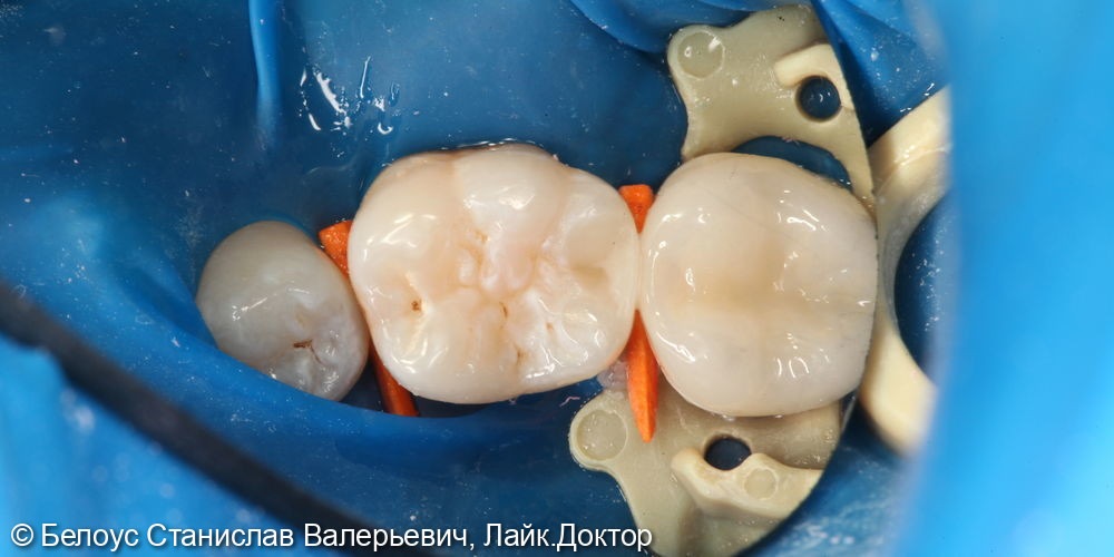 Лечение глубокого кариеса на жевательной поверхности 3.6 зуба - фото №5