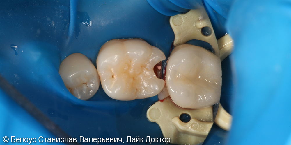 Лечение глубокого кариеса на жевательной поверхности 3.6 зуба - фото №1