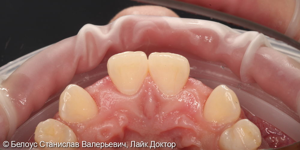 Установка имплантов и временных коронок 1.2 и 2.2 зуба - фото №2