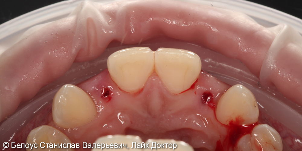 Установка имплантов и временных коронок 1.2 и 2.2 зуба - фото №4