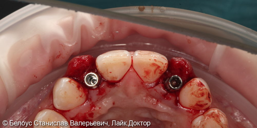 Установка имплантов и временных коронок 1.2 и 2.2 зуба - фото №5