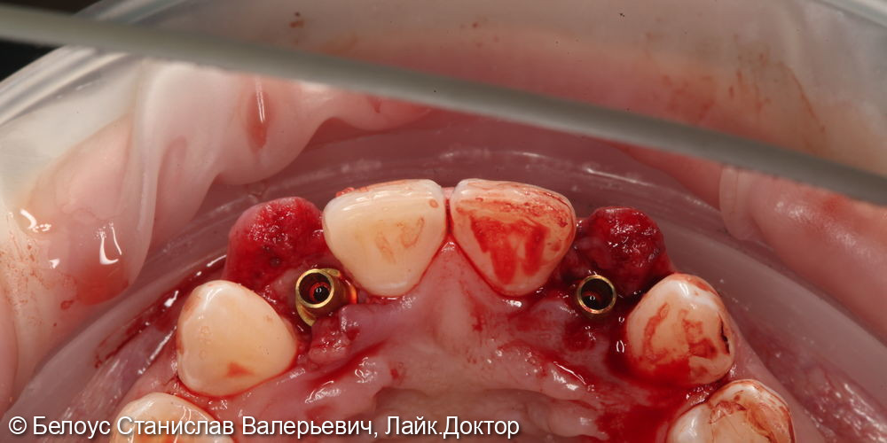 Установка имплантов и временных коронок 1.2 и 2.2 зуба - фото №6