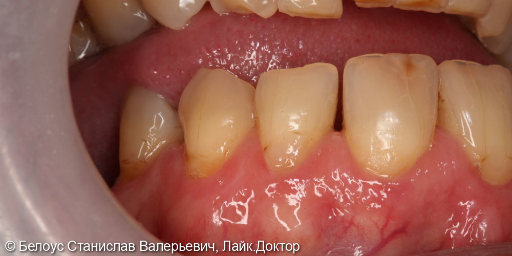 Лечение клиновидных дефектов 2.4 и 2.5 зуба - фото №1