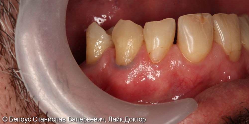 Лечение клиновидных дефектов 2.4 и 2.5 зуба - фото №2