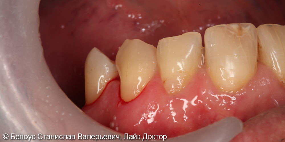Лечение клиновидных дефектов 2.4 и 2.5 зуба - фото №3