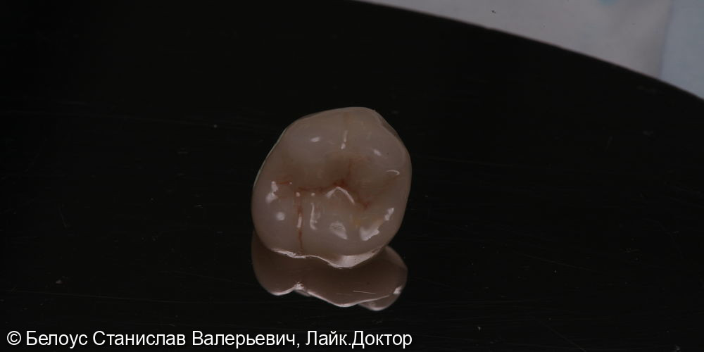 Установка керамической коронки CAD/CAM 16 зуба - фото №1
