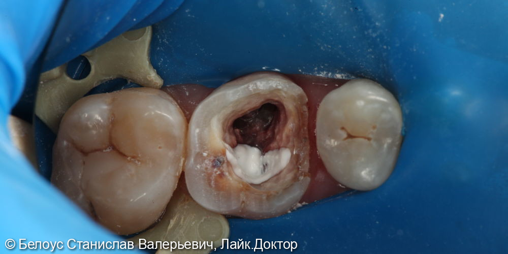 Лечение каналов в 2.6 зубе - фото №1