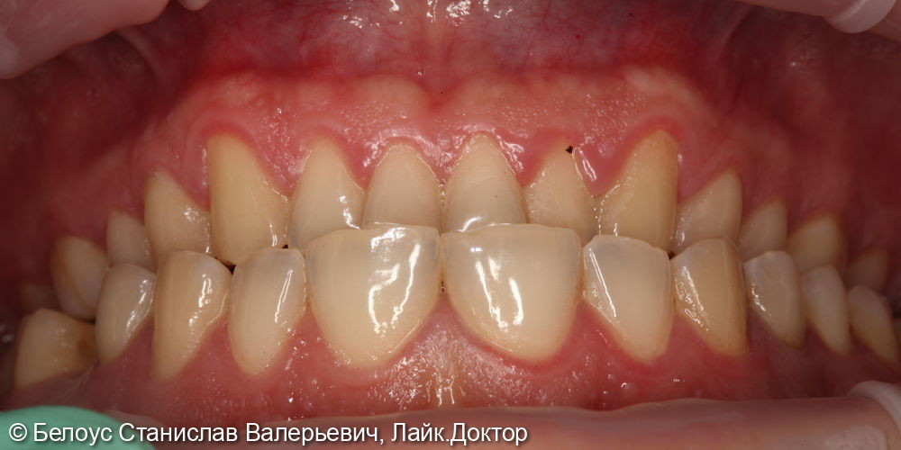 Профессиональная гигиена полости рта и клиническое отбеливание зубов zoom 4 - фото №1
