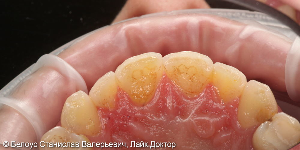 Профессиональная гигиена полости рта и клиническое отбеливание зубов zoom 4 - фото №2