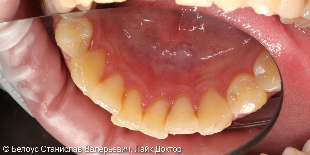 Профессиональная гигиена полости рта и клиническое отбеливание зубов zoom 4 - фото №3
