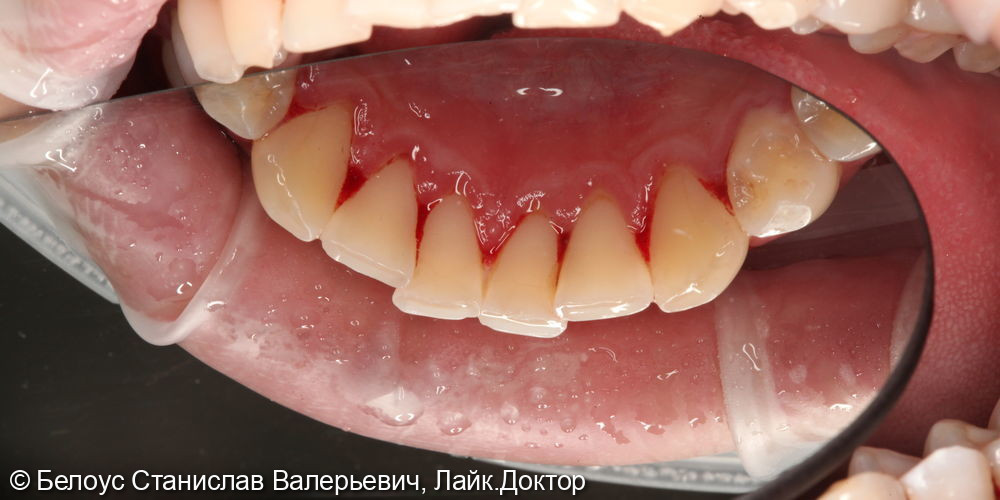 Профессиональная гигиена полости рта и клиническое отбеливание зубов zoom 4 - фото №4