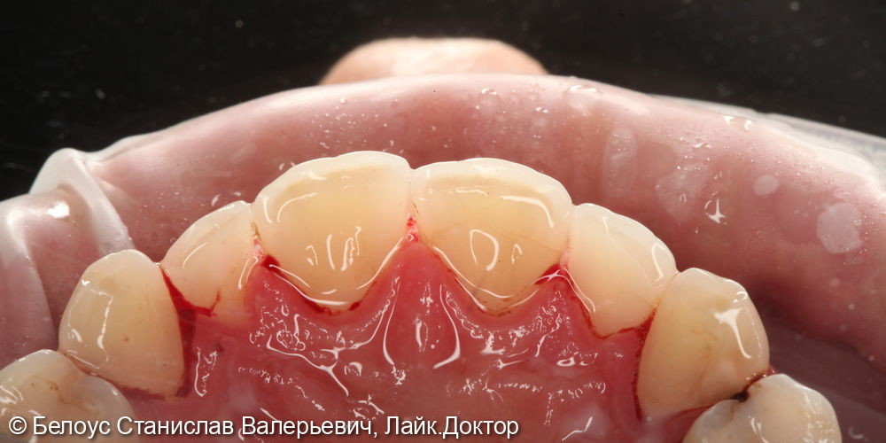 Профессиональная гигиена полости рта и клиническое отбеливание зубов zoom 4 - фото №5