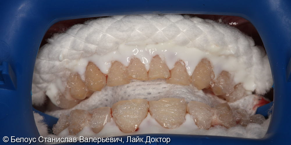 Профессиональная гигиена полости рта и клиническое отбеливание зубов zoom 4 - фото №6