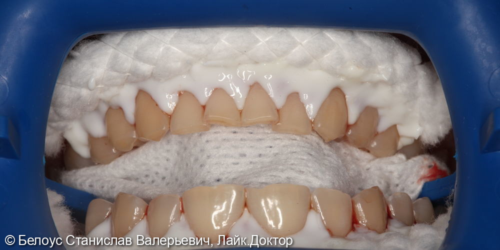 Профессиональная гигиена полости рта и клиническое отбеливание зубов zoom 4 - фото №7