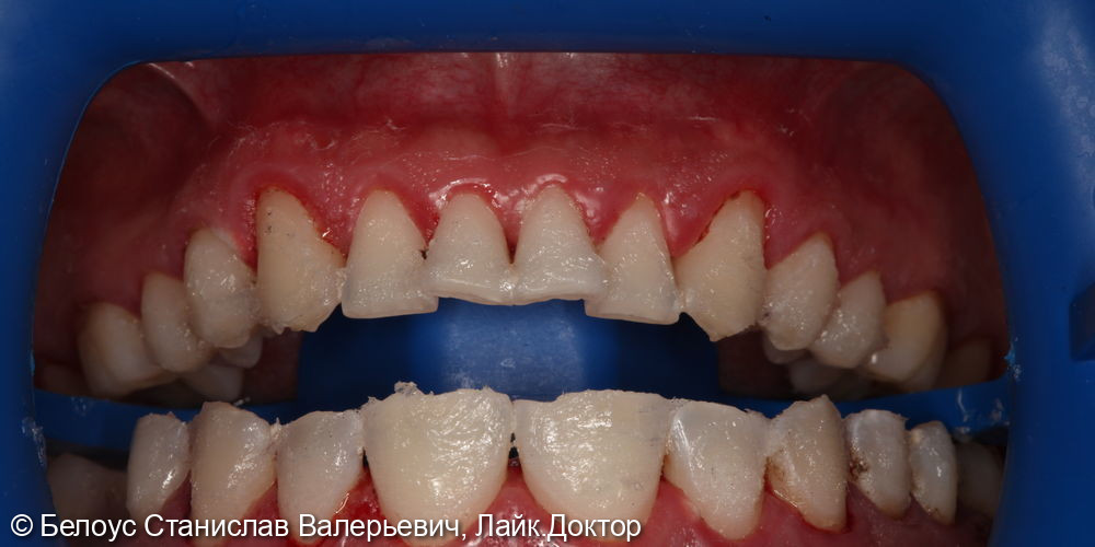 Профессиональная гигиена полости рта и клиническое отбеливание зубов zoom 4 - фото №8