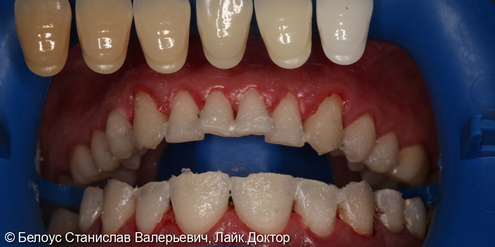 Профессиональная гигиена полости рта и клиническое отбеливание зубов zoom 4 - фото №9