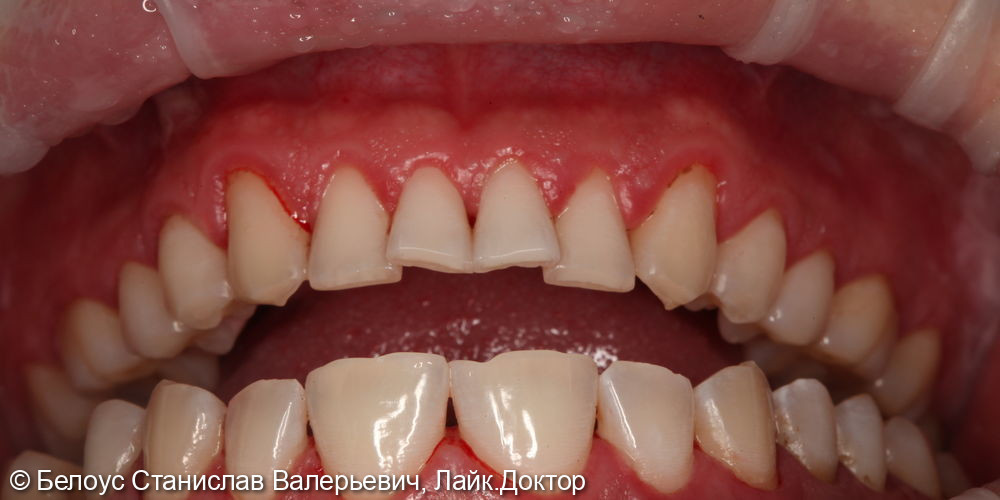Профессиональная гигиена полости рта и клиническое отбеливание зубов zoom 4 - фото №10