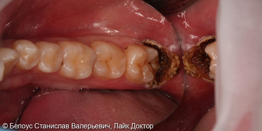 Перикоронит - причины, лечение воспаления капюшона зуба мудрости — ROOTT
