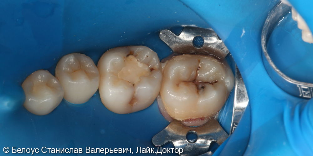 Лечение глубокого кариеса на жевательных поверхностях 46,47 зубов - фото №1