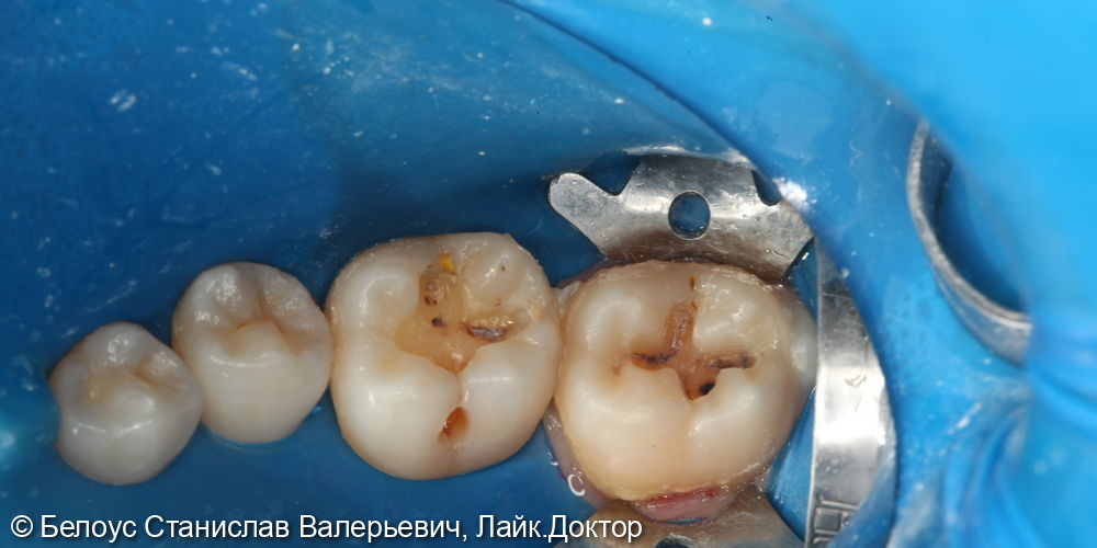 Лечение глубокого кариеса на жевательных поверхностях 46,47 зубов - фото №2