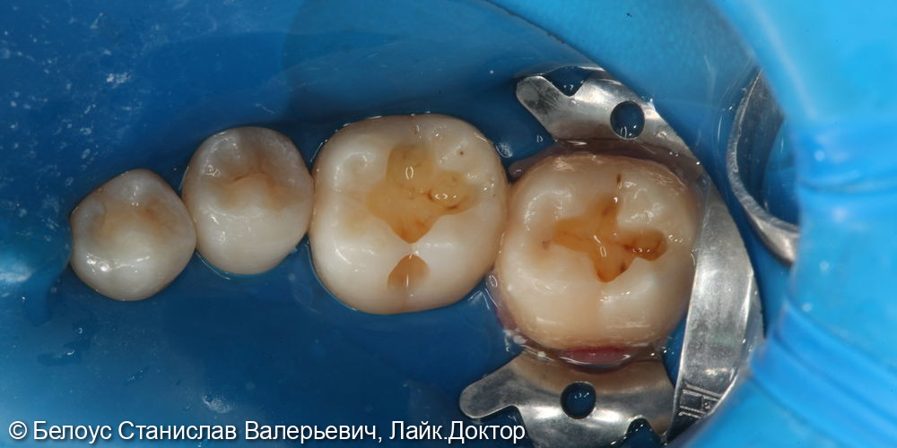 Лечение глубокого кариеса на жевательных поверхностях 46,47 зубов - фото №3
