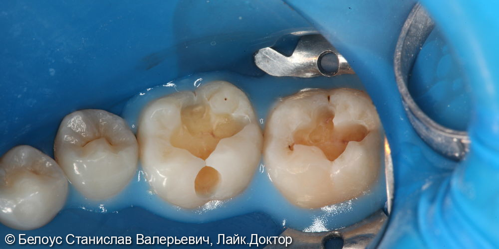 Лечение глубокого кариеса на жевательных поверхностях 46,47 зубов - фото №4