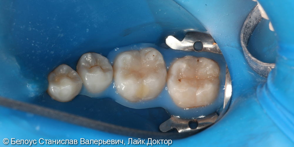 Лечение глубокого кариеса на жевательных поверхностях 46,47 зубов - фото №5
