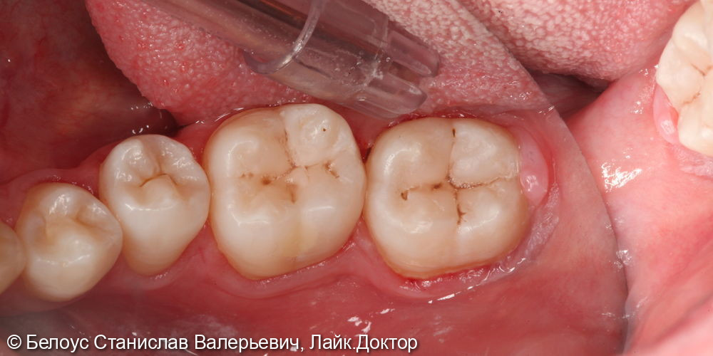 Лечение глубокого кариеса на жевательных поверхностях 46,47 зубов - фото №6