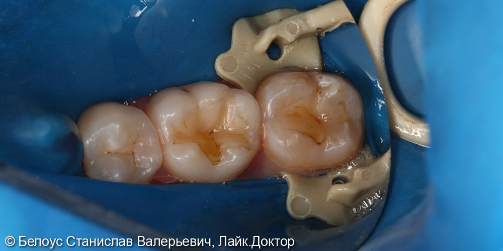 Лечение кариеса 3.6 и 3.7 зуба - фото №1