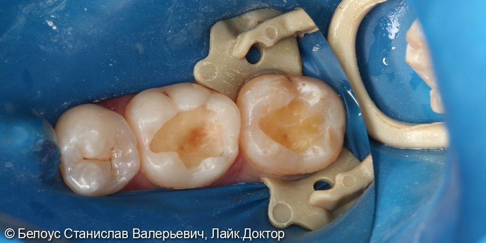 Лечение кариеса 3.6 и 3.7 зуба - фото №2