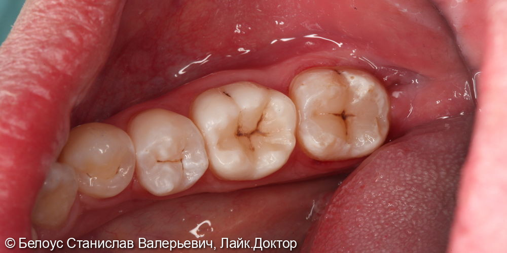 Лечение кариеса 3.6 и 3.7 зуба - фото №3