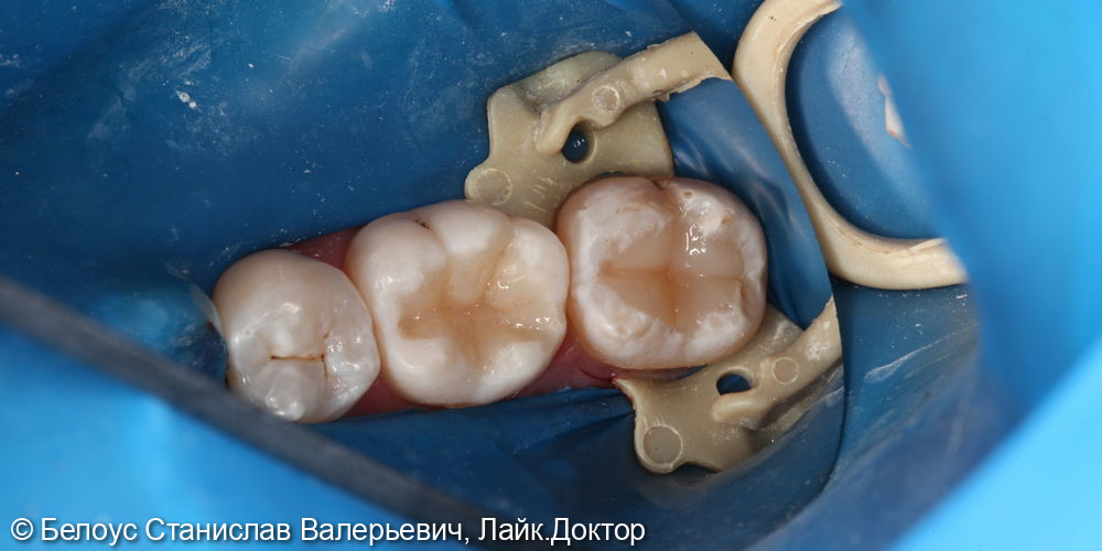 Лечение кариеса 3.6 и 3.7 зуба - фото №4
