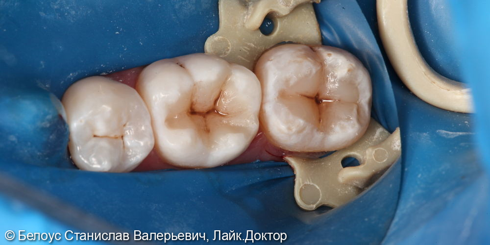 Лечение кариеса 3.6 и 3.7 зуба - фото №5