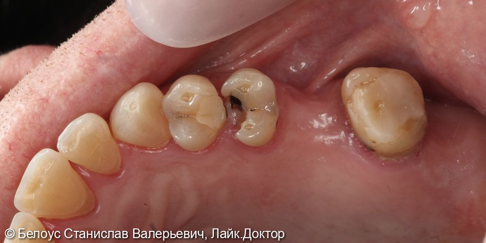 Восстановление зуба коронкой по технологии CEREC - фото №1