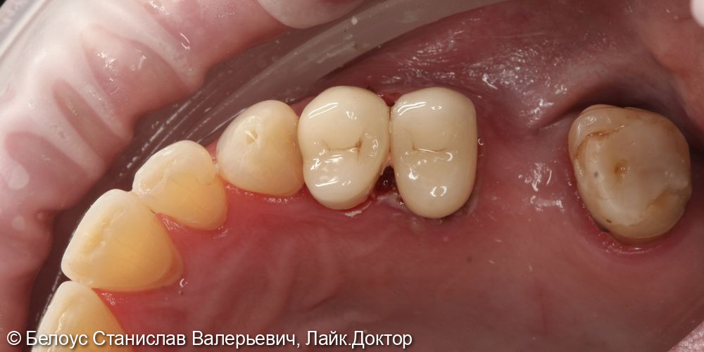 Восстановление зуба коронкой по технологии CEREC - фото №2