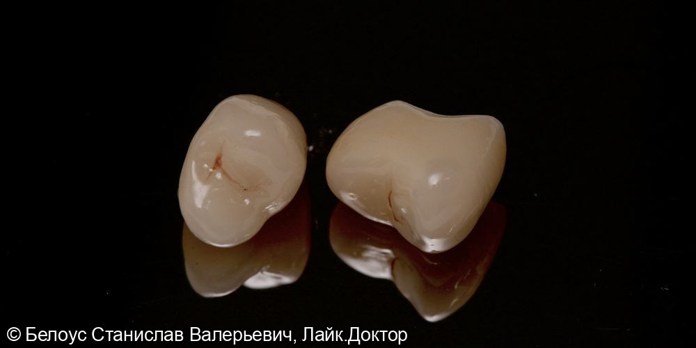 Восстановление зуба коронкой по технологии CEREC - фото №3