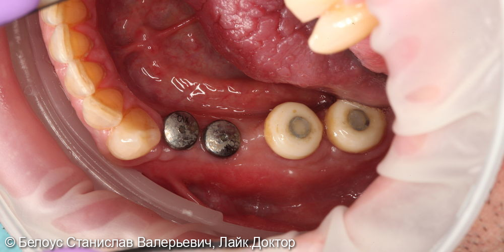 Имплантация 44-47 зубов - фото №2