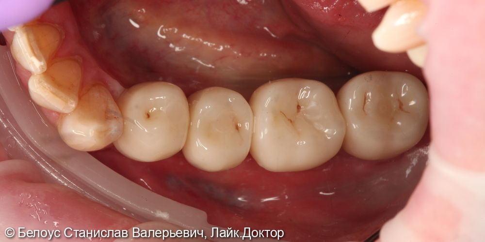 Имплантация 44-47 зубов - фото №3