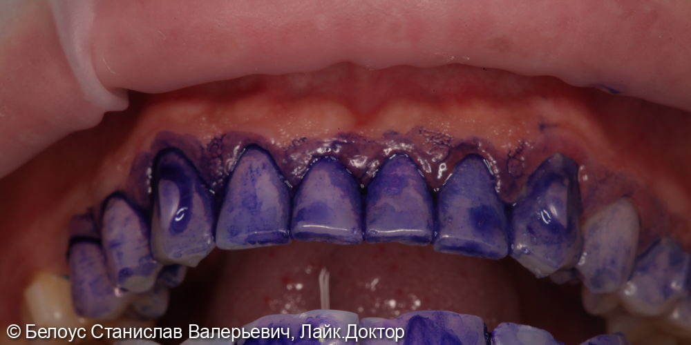 Гигиена полости рта по швейцарскому протоколу GBT - фото №1