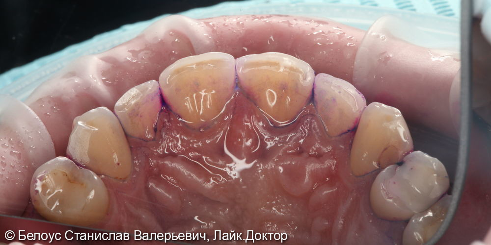 Гигиена полости рта по швейцарскому протоколу GBT - фото №3