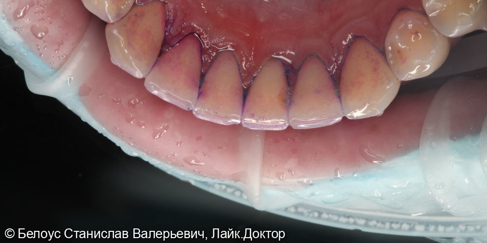 Гигиена полости рта по швейцарскому протоколу GBT - фото №4