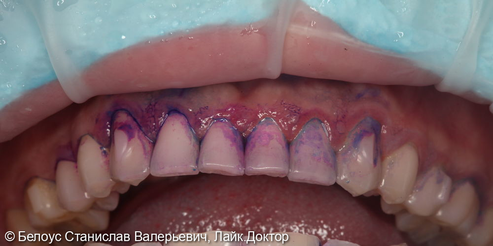 Гигиена полости рта по швейцарскому протоколу GBT - фото №5