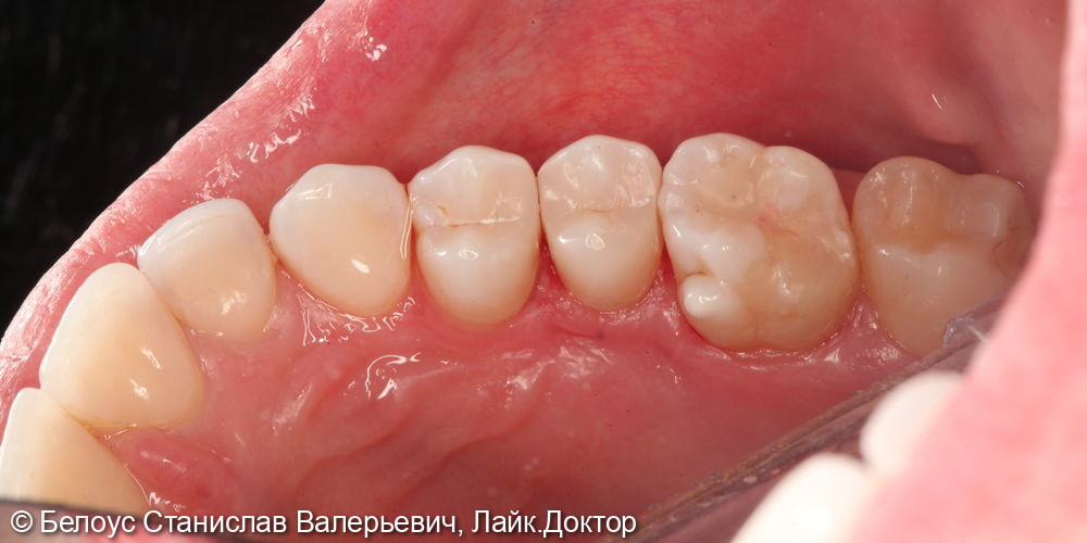 Лечение кариеса 14, 15 зубов - фото №2
