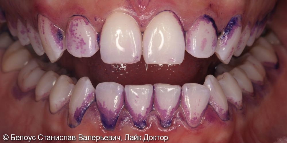 Профессиональная гигиена полости рта по протоколу GBT - фото №1