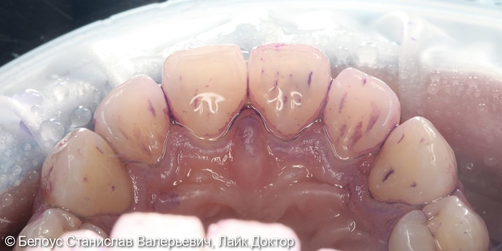 Профессиональная гигиена полости рта по протоколу GBT - фото №2