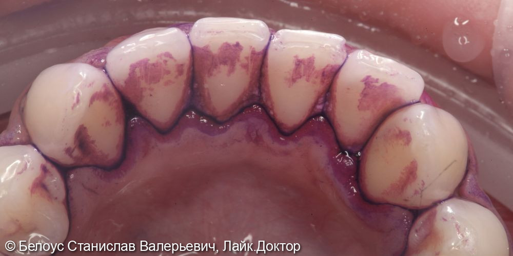 Профессиональная гигиена полости рта по протоколу GBT - фото №3