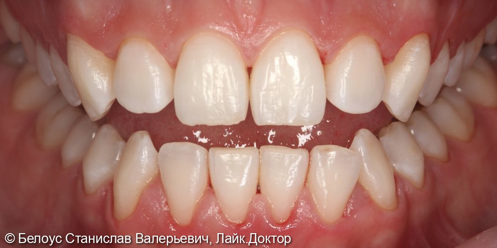 Профессиональная гигиена полости рта по протоколу GBT - фото №4
