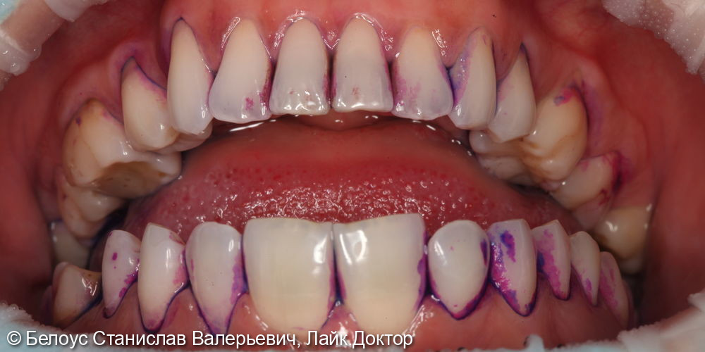 Профессиональная гигиена полости рта по швейцарскому протоколу Gbt - фото №1